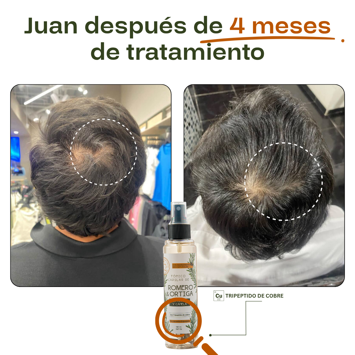 4x Tónico Anticaída - Tratamiento Completo 16 Semanas