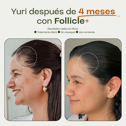 Tónico Capilar de Romero · Crecimiento y Anticaída + Dermaroller de regalo