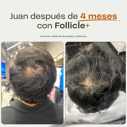 Tónico Capilar de Romero · Crecimiento y Anticaída + Dermaroller de regalo